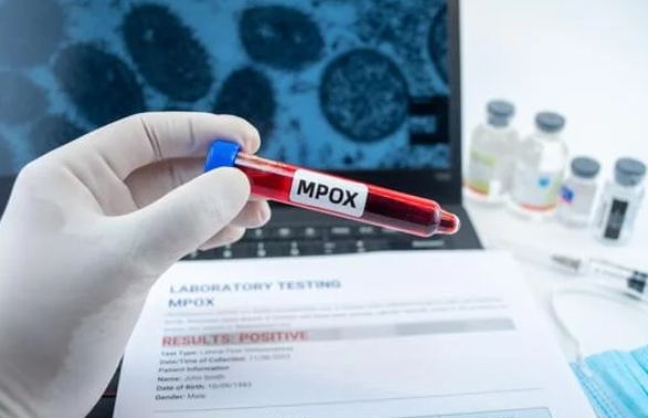 VIRUS MPOX : LES RECOMMANDATIONS DU MINISTERE DE LA SANTE